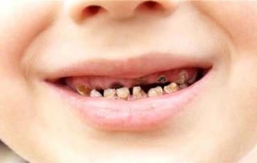 Mất răng – những nguy cơ tiềm ẩn